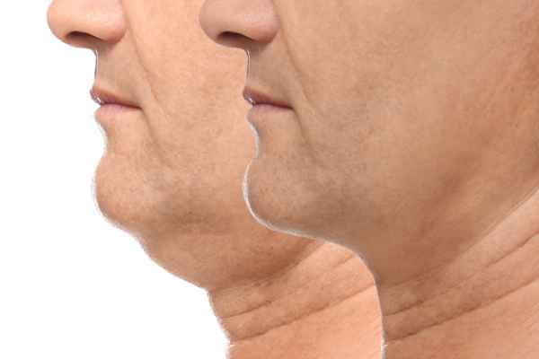 HIFU - Breakthrough in Anti - ageing 2 hifu results Cranleigh