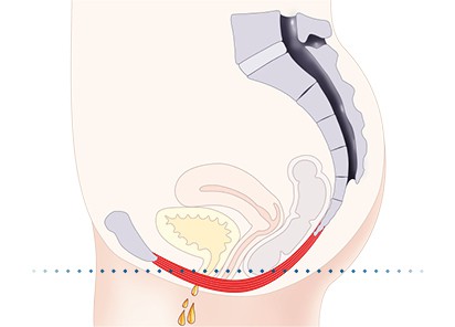 Pelvic-Floor Muscle Repair 5 Pelvic floor muscles Cranleigh
