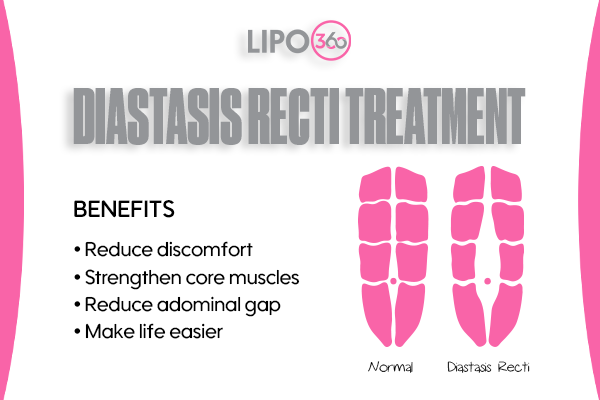 Revolutionising Muscle Repair: The Power of LIPO360 Body Sculpt Post-Injury 5 diastasis recti treatment Cranleigh