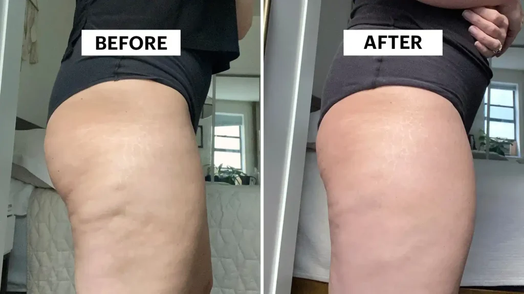 Sculpting Your Bum: Can Toning Exercises Really Reduce Cellulite? 1 Do Toning Exercise Cranleigh Really Tackle Cellulite?