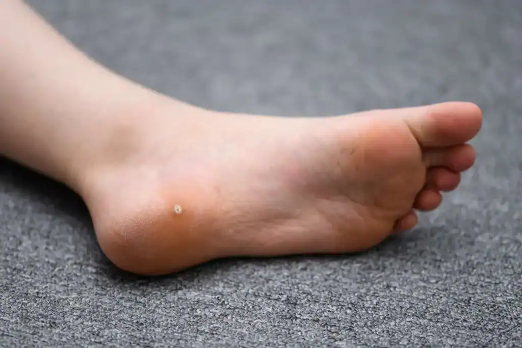 Cryotherapy For Warts And Also Verrucas 2 Image of verruca on the bottom of the foot that able to be treated with Cryotherapy Cranleigh
