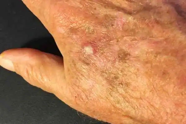 Cryopen For Actinic Keratoses 1 Image of Actinic keratoses Cranleigh on a person hand