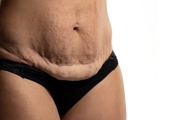 The science behind skin tightening Cranleigh picture of a woman's sagging skin on the stomach